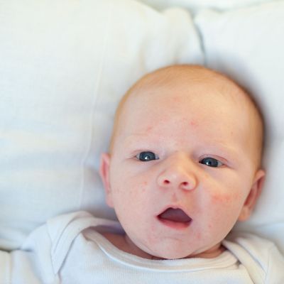 Ναι, η βρεφική ακμή είναι υπαρκτή - και πιο συνηθισμένη από όσο νομίζετε