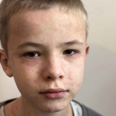 Ιλαρά: Οδηγός πρόληψης για γονείς