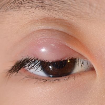 Το παιδί μου έχει κριθαράκι στο μάτι -Τι πρέπει να κάνω;