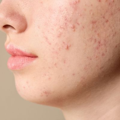 Καλοκαιρινή έξαρση ακμής σε έφηβους: Αιτίες και πρακτικές λύσεις