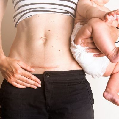 Τι πραγματικά συμβαίνει κατά τη διάρκεια μιας καισαρικής τομής – και πόση ώρα διαρκεί