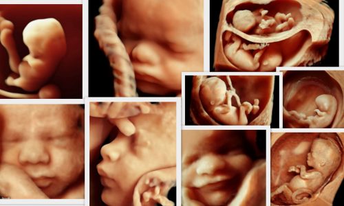 Νέο τρισδιάστατο υπερηχογράφημα δείχνει το μωρό μας με απίστευτη ακρίβεια!