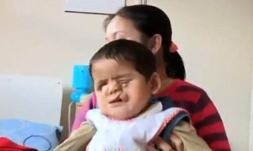 Συγκλονιστικό: Το αγοράκι που απέκτησε καινούργιο πρόσωπο! (βίντεο)