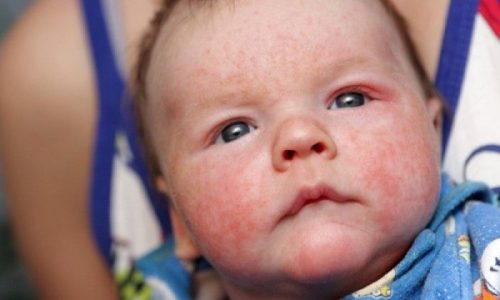 Περιστοματική δερματίτιδα: Αίτια, συμπτώματα, αντιμετώπιση