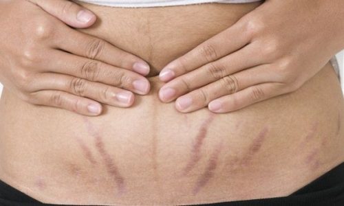 Ραγάδες στην εγκυμοσύνη: Δείτε πώς θα σας βοηθήσει να τις εξαφανίσετε ένα λεμόνι!