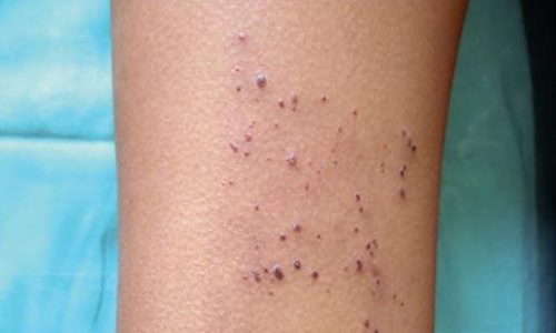 Νόσος Fabry: Τι είναι και τι μπορεί να προκαλέσει στα παιδιά