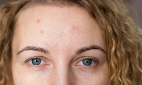 Ακμή ενηλίκων: 7 αιτίες που δεν γνωρίζετε και τρόποι αντιμετώπισης