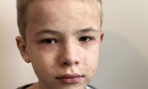 Ιλαρά: Οδηγός πρόληψης για γονείς