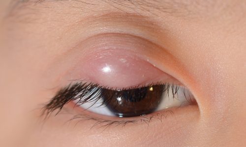 Το παιδί μου έχει κριθαράκι στο μάτι -Τι πρέπει να κάνω;