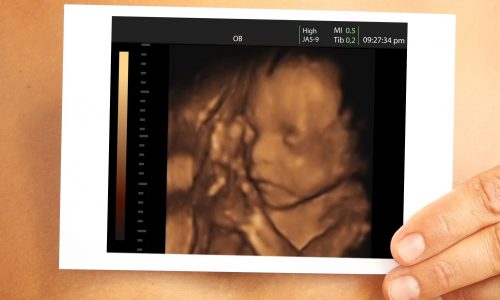 Καρδιοτοκογράφημα (Non-Stress Test/ NST): Μια ασφαλής και απλή μέθοδος παρακολούθησης του εμβρύου