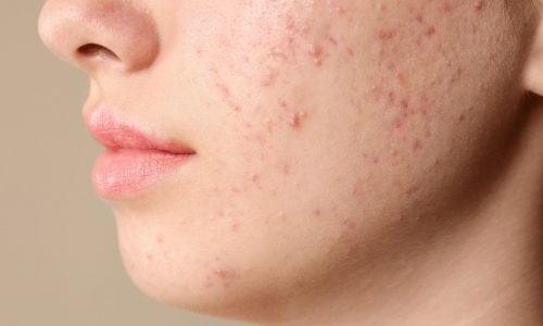 Καλοκαιρινή έξαρση ακμής σε έφηβους: Αιτίες και πρακτικές λύσεις