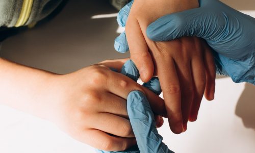 Κονδυλώματα στα παιδιά: Γιατί εμφανίζονται και τι να κάνετε