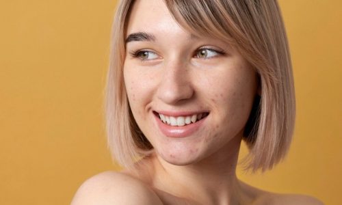 Ακμή στο πρόσωπο: Η ολοκληρωμένη ρουτίνα για καθαρή και λεία επιδερμίδα