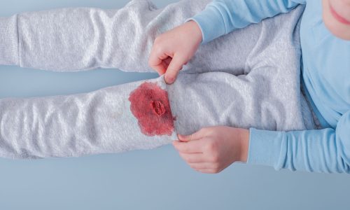 Λεκές από αίμα: Κρύο ή ζεστό νερό πρέπει να χρησιμοποιήσετε;