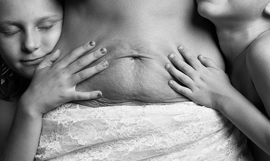 Kοιλιοπλαστική μετά τη γέννα-Όλα όσα πρέπει να γνωρίζετε