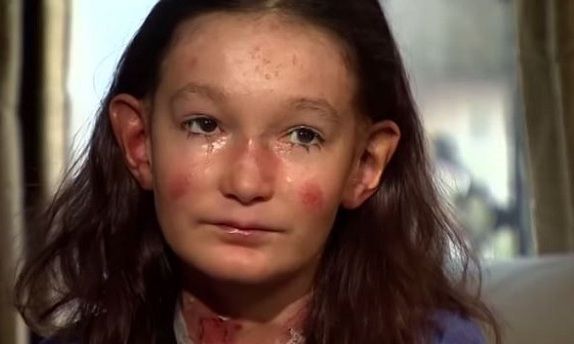 Δείτε από ποια σπάνια ασθένεια υποφέρει αυτό το 12χρονο κορίτσι! (βίντεο)