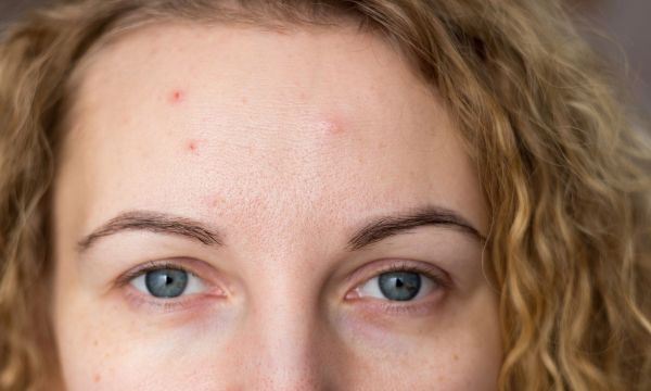 Ακμή ενηλίκων: 7 αιτίες που δεν γνωρίζετε και τρόποι αντιμετώπισης