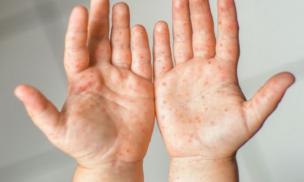 Πώς μεταδίδεται ο ιός κοξάκι, ποιοι είναι οι παράγοντες κινδύνου & φώτο να τον αναγνωρίσετε