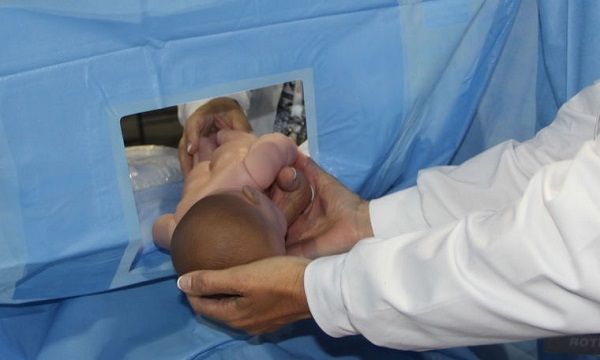 Καισαρική τομή: Δείτε τι εφηύραν μαίες για να αγκαλιάζει μια μαμά αμέσως το νεογέννητο