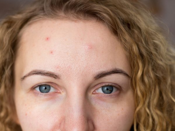 Ακμή ενηλίκων: 7 αιτίες που δεν γνωρίζετε και τρόποι αντιμετώπισης