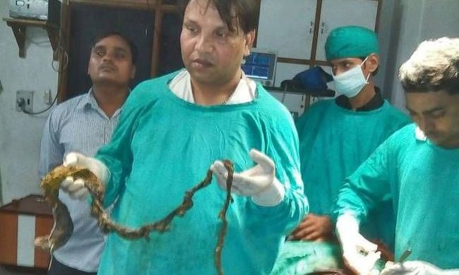 Δείτε τι σοκαριστικό αφαίρεσαν από το στομάχι 15χρονης με «σύνδρομο Ραπουνζέλ» (βίντεο)