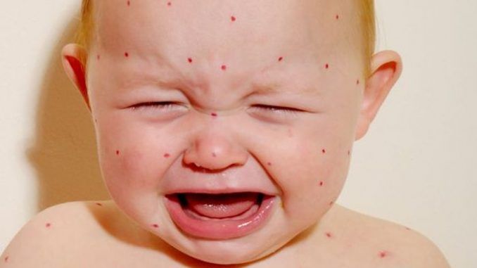 mmr causing measles outbreak 678x381