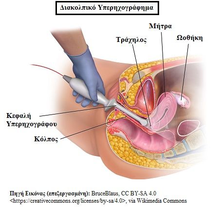 diakolpiko yperhxografhma1